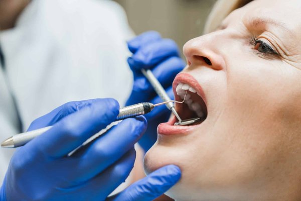 Comment reconnaître une carie dentaire ?